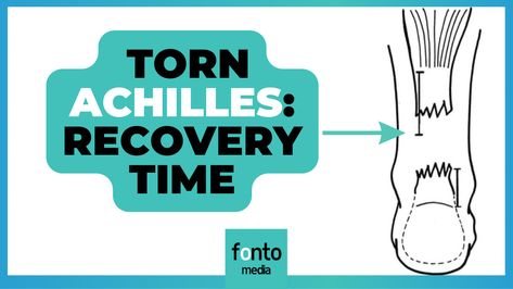 diagram of torn achilles and recovery time, how to do Achilles Tendon Surgery Recovery, Achilles Tendon Repair Recovery, Achilles Recovery, Ruptured Achilles, Torn Achilles Tendon, Achilles Rupture Recovery, Achilles Tendon Ruptures, Ankle Pain Relief, Achilles Pain