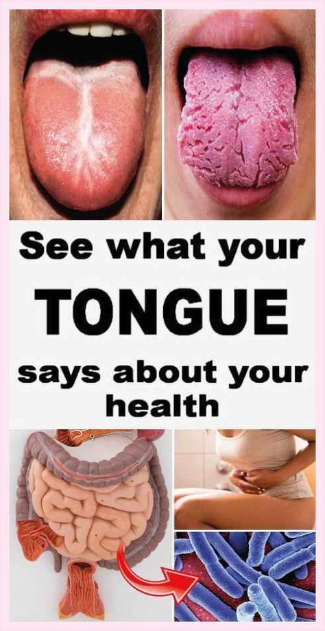 WHAT YOUR TONGUE IS TRYING TO TELL YOU ABOUT YOUR HEALTH Cracked Tongue, Health Resolutions, Bad Diet, Health Signs, Tongue Health, The Tongue, Naturopathy, Body Organs, Nail Health