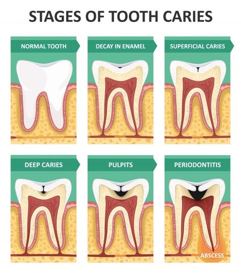 Stages of tooth caries | Premium Vector #Freepik #vector #medical #dental #dentist #tooth Stages Of Tooth Decay, Tooth Caries, Dental Poster, Good Teeth, Dental Assistant Study, Dental Images, Dental Assisting, Dental World, Dental Posts