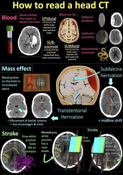 Ct Head Anatomy, Diagnostic Radiography, Medical Radiography, Radiology Student, Medicine Notes, Medical School Life, Medicine Studies, Basic Anatomy And Physiology, Nurse Study Notes