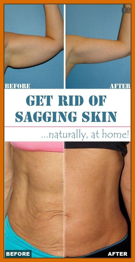 10 Easy Methods to Tighten Your Skin Naturally! Home Remedies For Skin, Tighten Loose Skin, Crepey Skin, Saggy Skin, Natural Health Tips, Skin Remedies, Trening Abs, Loose Skin, Skin Care Remedies