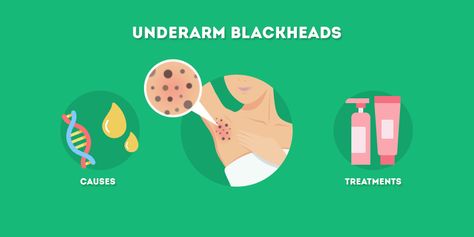 Blackheads Inner Thigh, Inner Thigh Blackheads How To Get Rid, Exfoliation Routine, Blackhead Extraction, Clear Blackheads, Exfoliating Sponge, Chemical Exfoliation, Skin Goals, Blackhead Mask