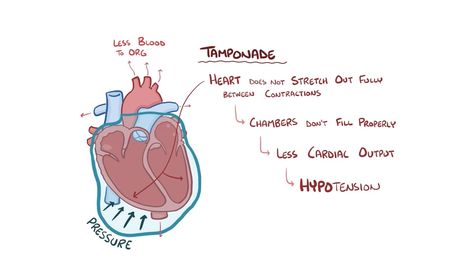 File:Cardiac tamponade.webm - Wikimedia ... Cardiac Tamponade, Emt Basic, Cardiac Sonography, Pericardial Effusion, Physician Assistant School, Ekg Interpretation, Med Notes, Nurse Study, Nurse Study Notes