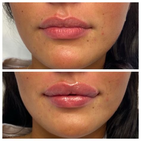 💋 Heart-Shaped Perfection Alert! 💖 Check out these stunning lip results from Front Door Medspa. Our patient desired a more pronounced upper lip, and Lauren R.N., our skilled injector, delivered just that with Juvederm Ultra. The result? Absolute heart-shaped perfection for this gorgeous girl! Dreaming of your perfect pout? Let us craft it for you. 💉✨$499 full syringe $350 half Book now  248-BEST SPA (237-8772) Lip Heart Shape, Heart Shape Lips Fillers, Bigger Upper Lip, Heavy Upper Lip, Desired Lips, Heart Shaped Lips, Skin Anatomy, Lip Filler, Lip Enhancement