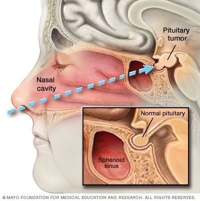 Pituitary Gland Tumor, Human Body Vocabulary, Anatomy Education, Basic Anatomy And Physiology, Adrenal Health, Pituitary Gland, Brain Anatomy, Human Body Anatomy, Medical Anatomy