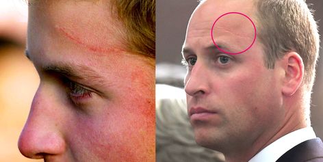 Prince William has a legit Harry Potter scar on his forehead and the story behind it is wild #scars #celebscars #newgelplus Kayla Adams, Harry Potter Scar, Eye Scar, Facial Scars, Private Dinner, Clarence House, Playing Golf, Royal Engagement, Body Picture