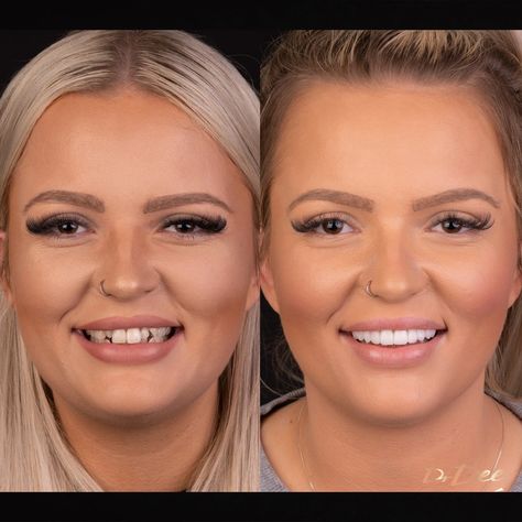 Our results gallery shows before and after images for treatments such as porcelain veneers, Invisalign Lite, Invisalign Full, teeth whitening, and gum laser surgery, N Images, Teeth Makeover, Permanent Dentures, Teeth Whitening Methods, Tooth Crown, Composite Veneers, Plastic Surgery Gone Wrong, Celebrity Smiles, Dental Aesthetics