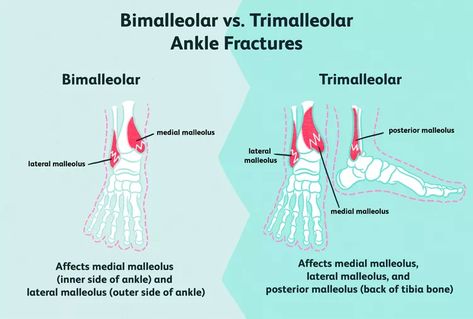 Bimalleolar and Trimalleolar Ankle Fractures Causes and More Ankle Fracture, Broken Ankle, Ligament Injury, Surgical Tech, Orthopedic Surgery, Strong Bones, Sports Injury, Surgery, Medical