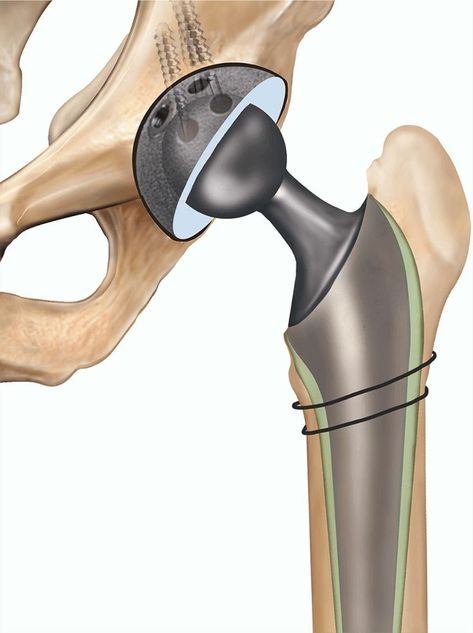 Revision Hip Replacement in West Delhi Body Joints, Wound Care, Hip Pain, Virginia Beach Va, Muscle Pain, Medical Prescription, Knee Pain, Virginia Beach, Physical Therapy