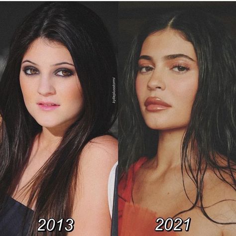 Kendall Jenner Surgery, Rhinoplasty Nose Jobs, Stormi Webster, Face Surgery, Plastic Surgery Gone Wrong, Graphic Makeup, Celebrity Plastic Surgery, Celebrities Before And After, Unique Makeup