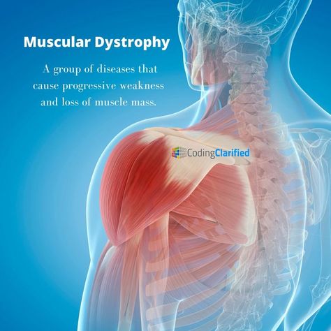 Depleting muscle mass and weakness that progressively gets worse are signs of muscular dystrophy. Abnormal mutations in genes and muscle degeneration typically becomes apparent in childhood. #medicalcoder #medicalcoding #musculardystrophy Food To Gain Muscle, Massage Training, Prenatal Massage, Body Pump, Increase Muscle Mass, Collagen Supplements, Massage Therapist, Muscle Mass, Bodyweight Workout