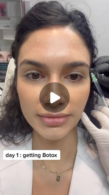 Botox Face Lift Before And After, Botox Eleven Lines, Dao Botox Injection Before And After, Dao Botox Before After, Botox Smile Lines Before After, Botox Face Lift, Forehead Botox Before And After, Baby Botox Before And After, Botox Areas On Face