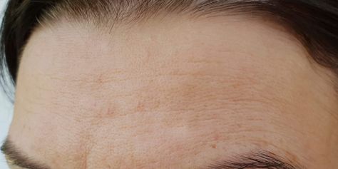 How to Get Rid of Forehead Wrinkles, Dehydration Lines Textured Forehead Bumps, How To Get Rid Of Deep Forehead Wrinkles, Bumpy Forehead, How To Remove Wrinkles On Forehead, Skincare For Forehead Wrinkles, Forehead Wrinkles, Exfoliating Cleanser, Skin Benefits, Moisturizer With Spf