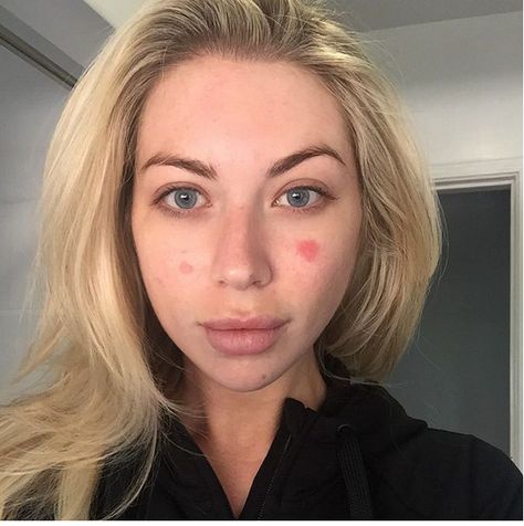 Stassi Schroeder from Vanderpump Rules gets real about her skin condition on Instagram. Marks On Face, Benefit Roller Lash Mascara, Chin Implant, Stassi Schroeder, Roller Lash Mascara, Tartelette In Bloom, Becca Highlighter, Airbrush Foundation, Anastasia Beverly Hills Brow