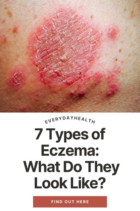 Dry Patches On Skin, Atopic Skin Care, Face Allergy Remedies Skin Care, Excema Remedies Diy, Skin Allergy Pictures, Skin Rashes Pictures Types Of, Myxedema Symptoms, Skin Irritation Remedies, Psoriatic Skin Natural Remedies