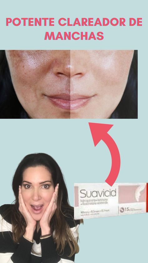 Pomada para clarear manchas do rosto. Suavicid Hormoskin Vitacid Plus Acne, Skin Care, Skin, Movie Posters, Film Posters