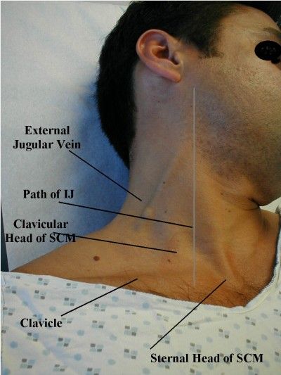 Jugular Venous Distention Jugular Venous Pressure, Jugular Vein, Surface Anatomy, General Medicine, Vascular Surgery, Health Assessment, Plant City, Critical Care Nursing, Nursing Life