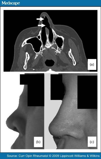 Surgical Interventions and Local Therapy for Wegener's Granulomatosis Wegeners Granulomatosis, Facial Paralysis, Paranasal Sinuses, Sinus Congestion Relief, Autoimmune Disorders, Congestion Relief, Pa School, Sinus Congestion, Health Guru