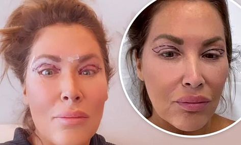 RHOC star Emily Simpson shares videos of her upper eyelid surgery Upper Eyelid Lift Surgery, Eyelid Lift Surgery Before After, Eye Lid Surgery Before And After, Eyelid Surgeries, Hooded Eye Surgery, Emily Simpson, Eye Lift Surgery, Surgical Gown, Tamra Judge