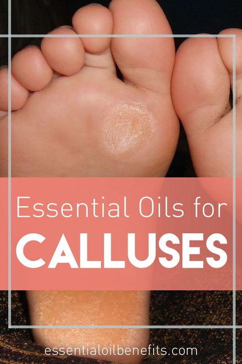 Essential oils for calluses. How to remove calluses with essential oils. How to get ride of calluses naturally. Callus Remover Diy, Callous Remover, Nail Remedies, Startup Tips, Oregano Essential Oil, Essential Oils For Pain, Essential Oils Guide, Essential Oils For Skin, Natural Sleep Remedies