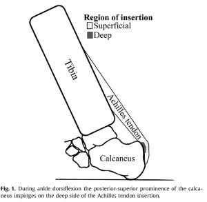 Treating Insertional Achilles Pain: Why We’ve Been Doing It All Wrong – Physiospot – Physiotherapy and Physical Therapy in the Spotlight Achilles Tendinopathy, Achilles Pain, Achilles Tendon, Back Stretches For Pain, Calf Raises, Muscle Training, Calf Muscles, In The Spotlight, Pain Free