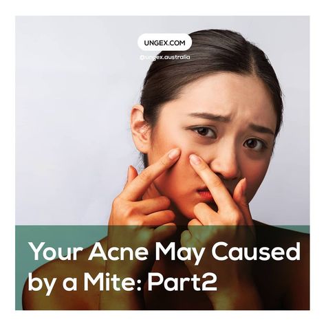 Skin Mites People, Causes Of Acne, Demodex Mites, Acne Causes, Oily Skin, Acne, Skin, Quick Saves