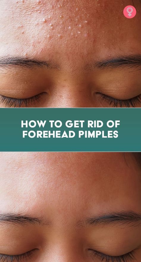 Forehead Pimples, Get Rid Of Forehead Acne, Forehead Bumps, Pimples On Forehead, Forehead Acne, Pimples Under The Skin, Bad Acne, Prevent Pimples, Pimples Remedies