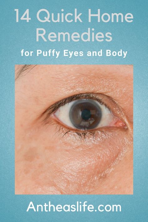 Many of us struggle frequently or occasionally with puffy feet, eyes, or faces which can be annoying. Here are 14 quick home remedies for puffy eyes and body. #healthyhabits #homeremedies #natural Puffy Eyes Crying, Puffy Under Eyes, Eye Bag Remedies, Puffy Eyes Remedy, Watery Eyes, Puffy Eyes, Eye Bags, Home Remedies, Natural Remedies