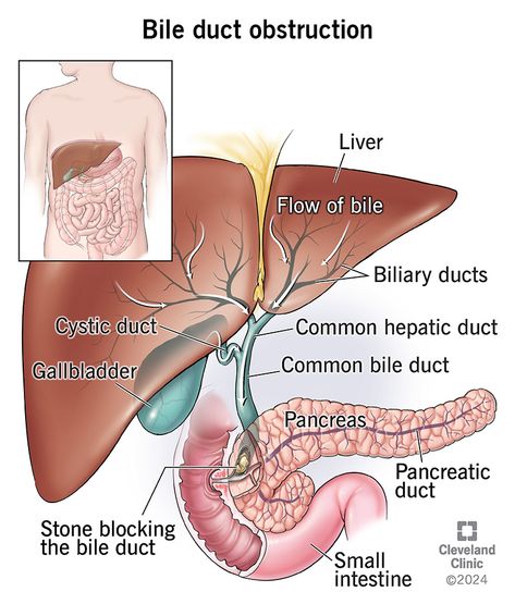 Jaundice Symptoms, Digestive Juice, Bile Duct, Cleveland Clinic, Chronic Inflammation, Abdominal Pain, Itchy Skin, Medical History, Medical School