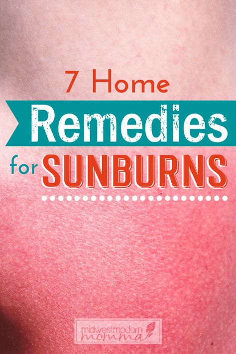 7 Home Remedies For Sunburns Sunburn Blisters, Remedies For Sunburn, Home Remedies For Sunburn, Get Rid Of Sunburn, Sunburn Peeling, Natural Remedies For Sunburn, Diy Natural Remedies, Bad Sunburn, Sunburn Remedies