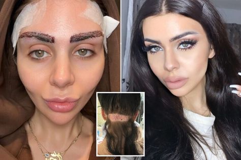 I overplucked my eyebrows as a teen — so I got a $5K transplant that makes me feel younger — New York Post Eyebrow Hair Transplant, Overplucked Eyebrows, Eyebrow Transplant, Perfect Eyebrow Shape, Facial Fillers, How To Grow Eyebrows, Thick Eyebrows, Perfect Eyebrows, Feel Younger