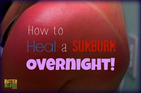 Sunburn Remedy: Instant Relief and Overnight Healing   I grabbed my sunburn remedy ingredients, and in just a few minutes, the stinging stopped and I was on my way to burn-free skin! By the very next day, it was basically gone. This works way better for me than aloe vera ever did!  Heal your sunburn overnight in just 2 steps Remember this remedy the next time you get a sunburn, and your skin will thank you. It’ll heal the burn much more quickly than you ever thought was possible! Heal Sunburn, Sickness Remedies, Burn Relief, Sunburn Remedies, Diy Medicine, Sunburn Relief, Sun Safety, Diy Remedies, Beach Please