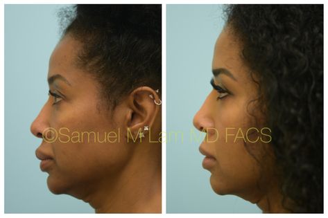 This African-American woman is shown before and  5 months after upper and lower lip reduction to correct previous bad permanent lip fillers. She also had facial fillers performed to create a more youthful and balanced face. She is shown to be younger and less bottom heavy on her face afterward. Lip Reduction, Lip Balm Tin, Bottom Heavy, Facial Fillers, Lower Lip, Lip Shapes, Layers Of Skin, Tinted Lip Balm, Lip Fillers