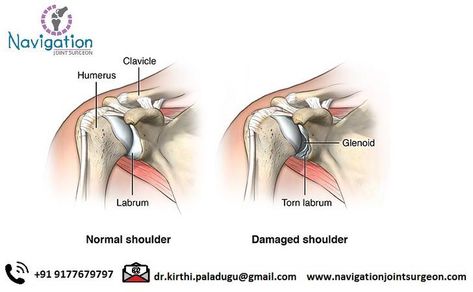 Torn Labrum Shoulder, Torn Labrum, Shoulder Rehab Exercises, Shoulder Dislocation, Shoulder Rehab, Shoulder Bones, Body Joints, Bone Loss, Rotator Cuff