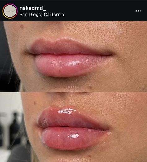 Lip Filler Round Lips, Lip Blush Permanent Makeup, Lip Filler Ideas, Lip Fillers Natural Look, Lip Filler On Full Lips, Lip Filler Inspiration Small Mouth, Types Of Lip Filler Shapes, Celebrity Lip Fillers, Keyhole Pout Lips