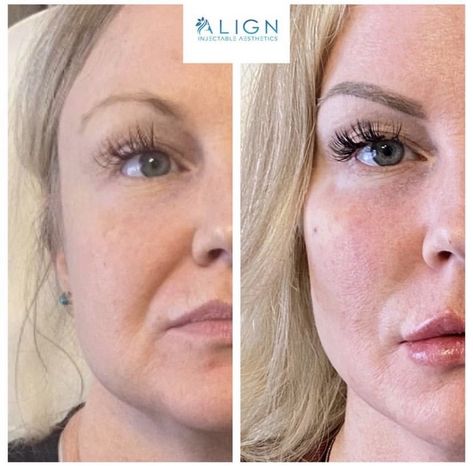 Filler In Cheeks Before And After, Before And After Fillers Faces, Cheek Fillers Before And After, Face Fillers Before And After Cheeks, Before And After Cheek Filler, Smile Lines Filler Before And After, Cheek Filler Before And After, Smile Line Fillers Before And After, Fillers Before And After