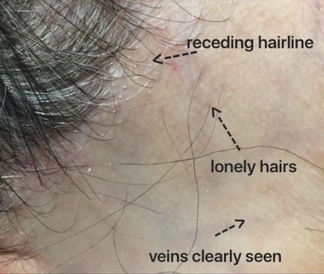 Frontal Fibrosing Alopecia — Donovan Hair Clinic Alopecia Eyebrows, Frontal Fibrosing Alopecia, Lichen Planopilaris, Scarring Alopecia, Alopecia Wig, Alopecia Hairstyles, Behind Ear Tattoos, Eyebrows Eyelashes, Sugar Skull Girl