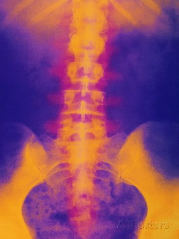 spine xray art print | Coloured X-ray of Normal Lower Spine And Pelvis Premium Poster Xray Art, Throat Infection, Scary Art, Pose Reference Photo, Affordable Wall Art, Aesthetic Images, X Ray, Cool Posters, Canvas Paintings