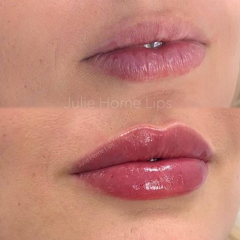 Best of Cosmetic Dermatology on Instagram: “Natural pout and crisp border with 1 ml Restylane Kysse 💉💋 Thoughts? . . Impressive work by @juliehornelips 🙌🙌 . . #Filler #fillers…” 1ml Of Lip Filler, Lip Filler 5ml, 1.5 Lip Filler, Vermillion Border Lip Filler, Lip Filler 1 Ml, Lip Filler Natural Look, Lip Filler Before And After 1ml, Natural Lip Fillers 1ml, Natural Lip Fillers 0.5ml