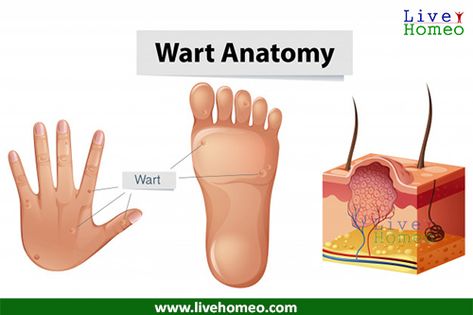 Plantar Warts How To Get Rid Of, How To Treat Warts, Natural Remedies For Warts, Different Types Of Warts, Different Headaches, Flat Warts, Types Of Warts, Natural Wart Remedies, Facial Warts