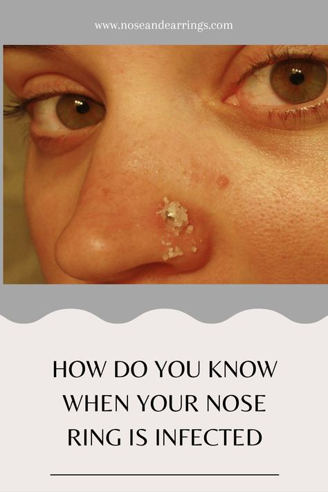 How Do You Know When Your Nose Ring Is Infected Infected Nose Ring, Nose Ring Bump, Infected Nose Piercing, Nose Piercing Infection, 8th Sign, Big Noses, Shape Of You, Nose Piercing, Health Remedies