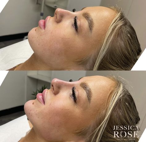 Pixie Tip Lift Nose Filler, Face Fillers Before And After Jaw, Nose Injections Before And After, Nose Botox Before And After, Facial Balancing Before And After, Nose Filler Before After, Face Fillers Before And After, Nose Job Inspiration Natural, Cheek Fillers Before And After Face