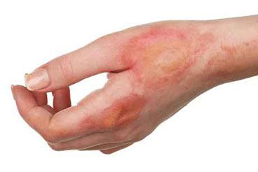 honey Home Remedies For Burns, Burn Remedy, Treat Burns, Degree Burns, Food Health Benefits, Skin Burns, Hand Burn, Burn Mark, Natural Treatments