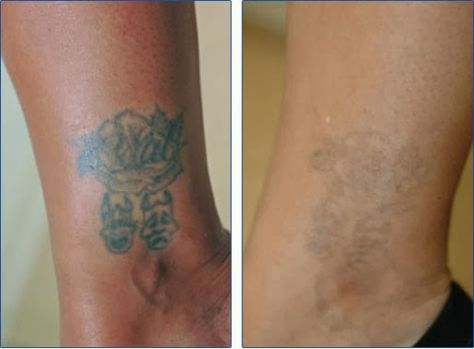 Natural Tattoo Removal: How To Remove Tattoos At Home - Dermabrasion Tattoos At Home, Tattoo Eraser, Natural Tattoo Removal, Tattoo Removal Cream, Tattoo Removal Cost, Faded Tattoo, Tattoo Off, Tattoo Cream, Tattoo Themes