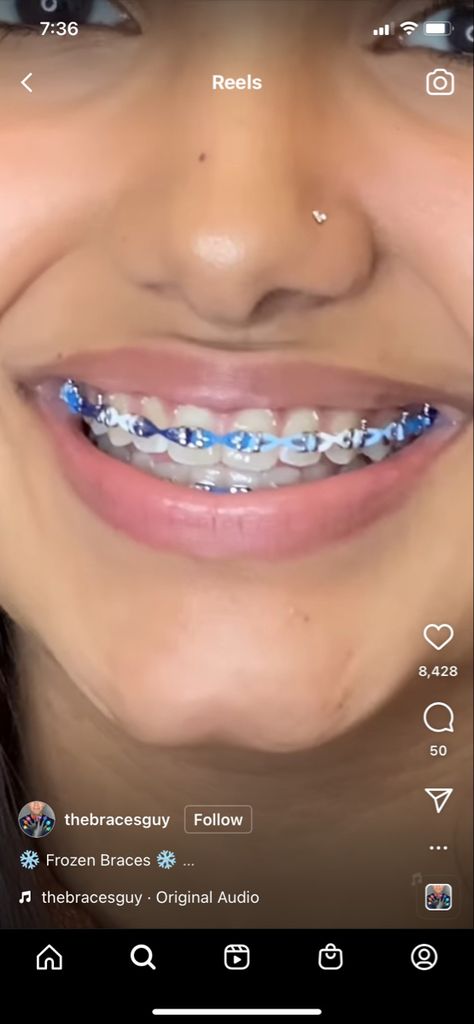 Braces Ideas, Cute Braces Colors, Cute Braces, Braces Colors, Cute Nail Art Designs, Cute Nail Art, Braces, Art Designs, Cute Nails