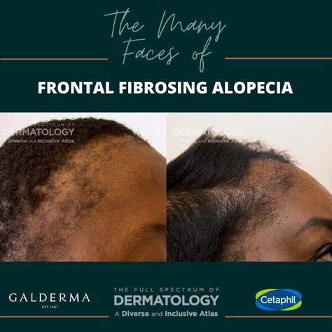 Before concluding a patient with thinning edges has traction or androgenic alopecia, take a closer look at the scalp, face, and other hair bearing areas of the body to complete the picture. You might be missing signs and symptoms of Frontal Fibrosing Alopecia. As seen in the images, FFA can have various presentation patterns on … Continue reading "The Many Faces of Frontal Fibrosing Alopecia (FFA)" The post The Many Faces of Frontal Fibrosing Alopecia (FFA) appeared first on Next Steps in Frontal Fibrosing Alopecia, Thinning Edges, Androgenic Alopecia, Traction Alopecia, Hair Coils, Hair Patterns, Different Skin Tones, Ffa, Signs And Symptoms