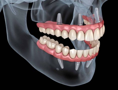 Losing a tooth is a hard experience; losing more than one is far worse. It’s... Prosthetic Teeth, Dental Studio, Bone Grafting, Dental Implant Surgery, Dental Implants Cost, What Can I Eat, Dental Design, Dental Marketing, Tooth Replacement