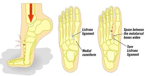 A Lisfranc injury is considered one of the dreaded conditions you can experience during sports as they can take a lot of time and energy to recover from! If you think you’ve experienced a Lisfranc injury, it’s essential you get it assessed and treated as quickly as possible. Calf Raises Exercise, Lisfranc Injury, Rehabilitation Exercises, Foot Injury, Calf Raises, Sports Injury, Lower Leg, Foot Pain, The Movement