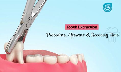 Tooth Extraction Wisdom Teeth Pain Relief, Teeth Extraction, Wisdom Teeth Pain, Tooth Pain Relief, After Wisdom Teeth Removal, Tooth Extraction Aftercare, Tooth Extraction Healing, Dental Extraction, Mouth Health