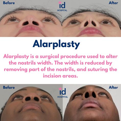 Alarplasty is a rhinoplasty procedure that is used to reduce the size of the nostrils. #idhospitalkorea #koreanplasticsurgery #plasticsurgery #plasticsurgerykorea #cosmeticsurgery #seoul #korea #rhinoplasty #asianrhinoplasty #barbierhinoplasty #plasticsurgeon #nosereduction #humpreduction #rhinoplasty #asianrhinoplasty #asiannosejob #nosehumpcorrection #nosehumpreduction #alarplasty Korea Rhinoplasty, Ethnic Rhinoplasty, Plastic Surgery Korea, Korean Plastic Surgery, Beauty Procedures, Nose Job, Seoul Korea, Plastic Surgeon, Cosmetic Surgery